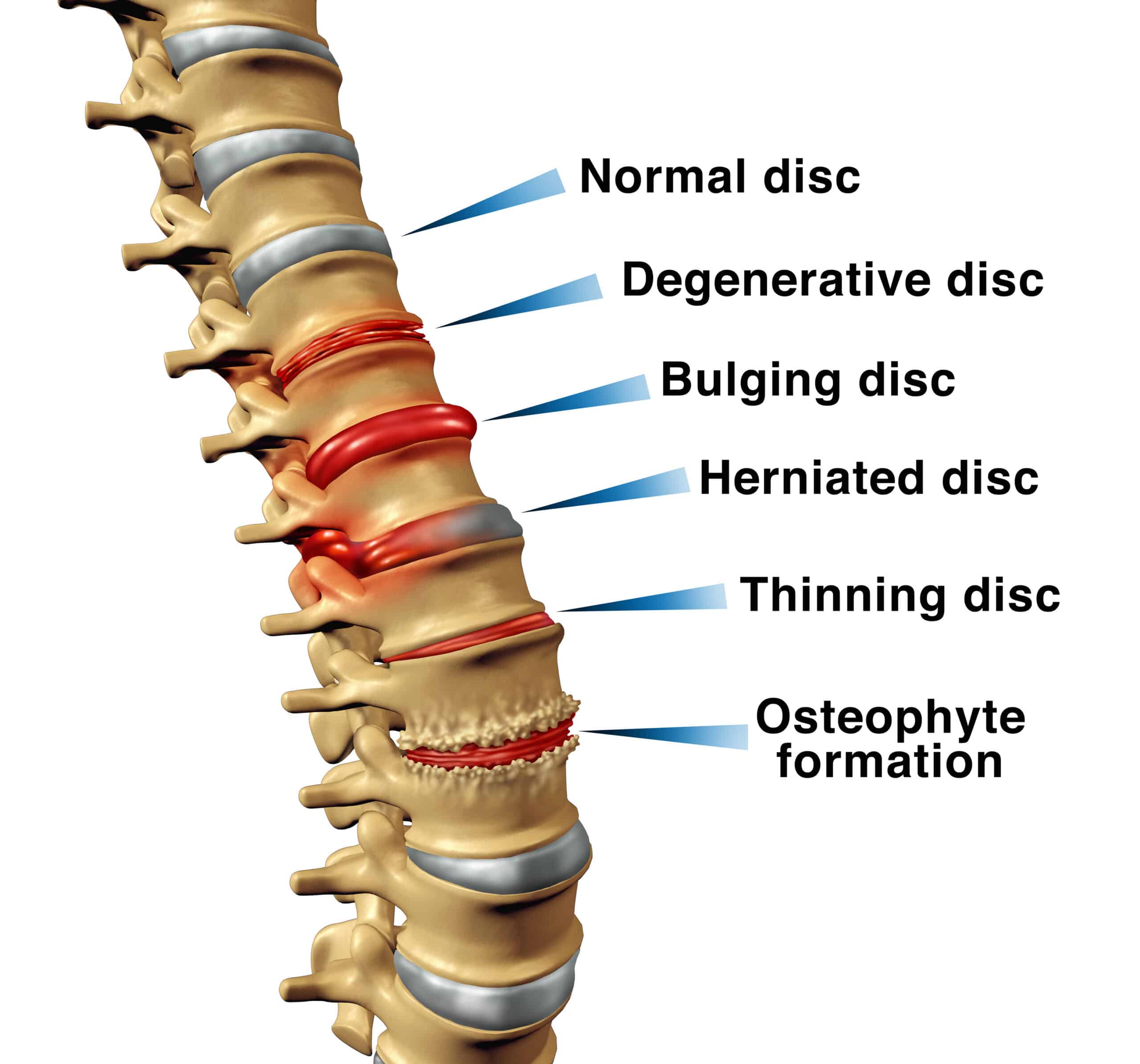 spine disorders graphic